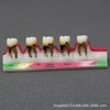 Dental teaching model doctor-patient communication model comprehensive case model removable dental model implant restoration model