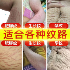 Stretch mark repair cream to remove pregnancy marks, postpartum repair cream to lighten obesity marks, remove growth marks, stretch mark firming cream