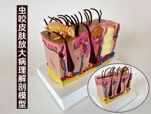 Insect bite skin damage model mite bite anatomy subcutaneous vascular nerve hair follicle beauty medical pathology skin map