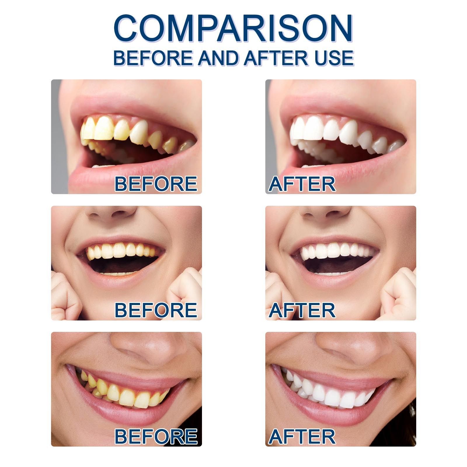 Jaysuing 牙齒精華液 牙斑淨美牙護理精華清潔牙垢黃漬牙漬配棉簽