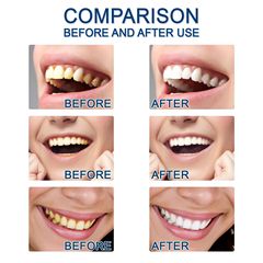 Jaysuing 牙齒精華液 牙斑淨美牙護理精華清潔牙垢黃漬牙漬配棉簽