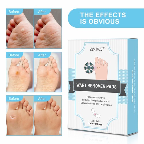 ELAIMEI Corn Patch Foot Patch painlessly removes plantar warts, calluses, foot calluses, and easily relieves pain