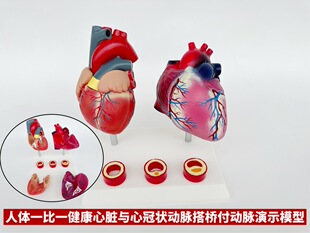 Human vascular pressure high pathological anatomy heart and viscera healthy heart vascular structure comparison teaching mold