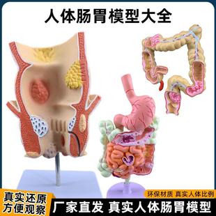Human Intestinal Stomach Coronal Structure Anatomy Model Duodenum Digestive System Hemorrhoids Lesion Demonstration Teaching Aids