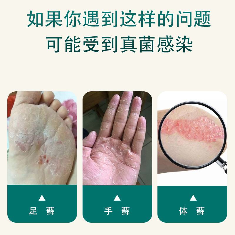 トゥオネン キトサン フット イージー スプレー 水虫、皮むけ、手足の腐った足、水疱、即効性、殺菌、かゆみ止め|undefined