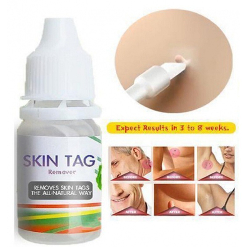 10ml スキンタグリムーバー いぼ治療 乳頭腫除去 クロスボーダー|undefined