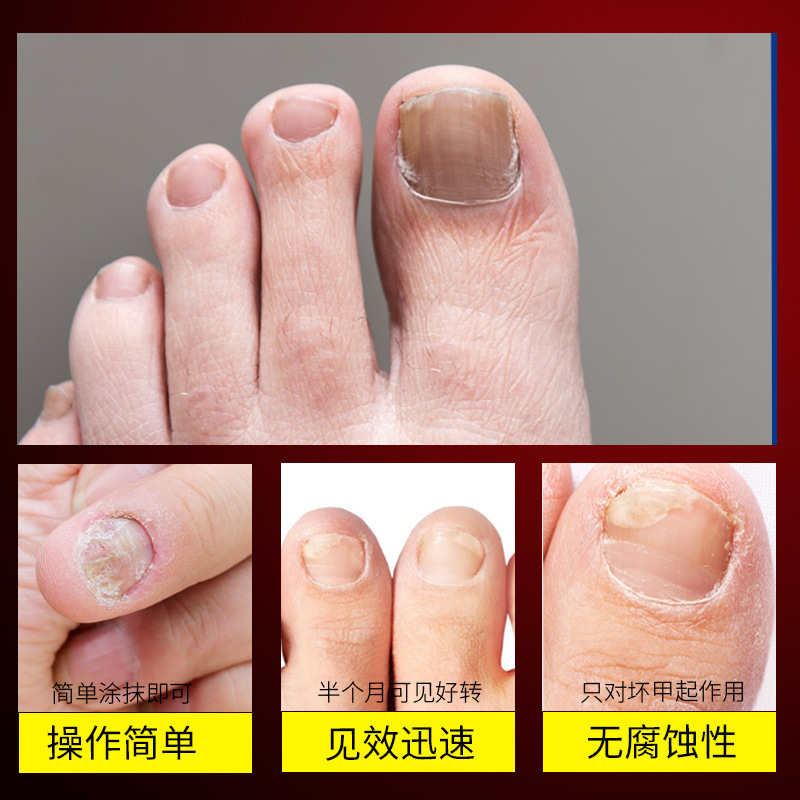 爪真菌症クリームメーカー在庫あり 爪真菌症除去クリーム 厚みのある柔らかい爪除去クリーム 家庭用ハーブ足爪ケアクリーム|undefined