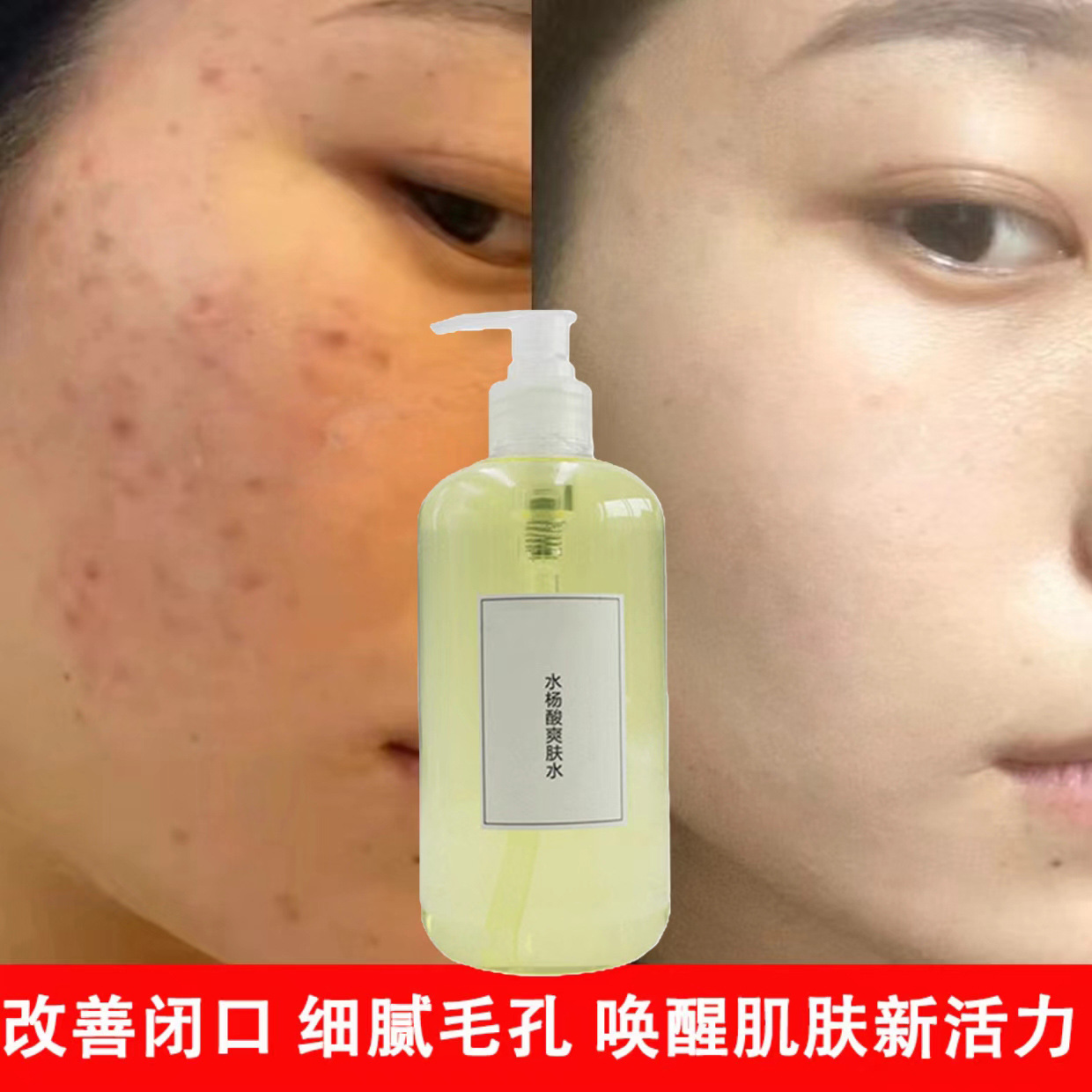 Salicylic Acid Toner to Remove Closed Acne, Wet Compress Essence, Remove Acne Marks, Repair Enlarged Pores, Fruit Acid Essence