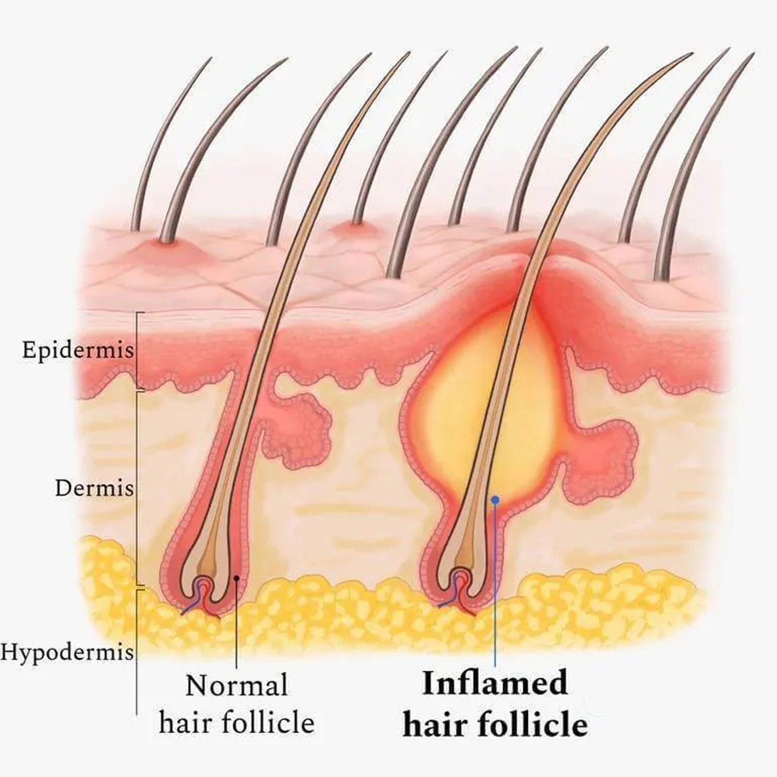 Olio essenziale EELHOE per la cura del cuoio capelluto e dei capelli, pulizia profonda del cuoio capelluto, riparazione delle radici dei capelli, antiprurito, prevenzione della caduta dei capelli e cura solida dei capelli_voghion.com