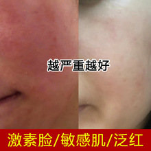 激素脸修护霜改善脸部泛红敏感肌肤舒缓修护增厚角质层积雪草面霜