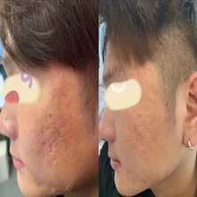 痘坑凹疤套盒韩国蛋白液产后修复妊辰纹肥胖纹川字纹微针导入