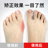 [A字型夹趾分离器大拇指脚趾外翻矫正器通用大脚骨夹趾垫矫形器]