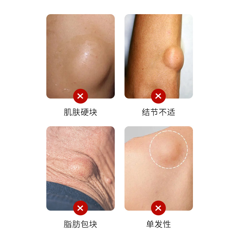 crema de salud para uso externo para aliviar grasa de grasa de grasa múltiple o grasa dura de grasa de grasa de grasa de grasa única