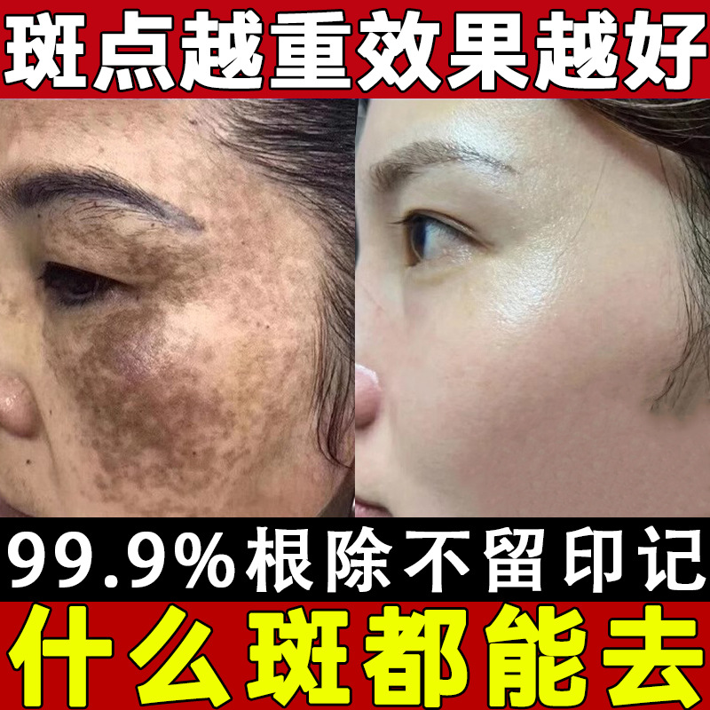 Beauty Salon Whitening and Freckle Removal Cream, Powerful Freckle Removal Cream, Melanin Removal, Chloasma Removal Cream, Freckle Removal Cream Set