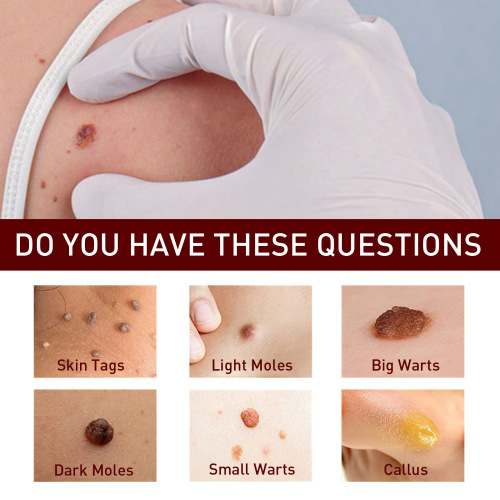 Jaysuing wart-killing pen smoothes skin, lightens corns, black moles, wart-killing skin tag removal liquid