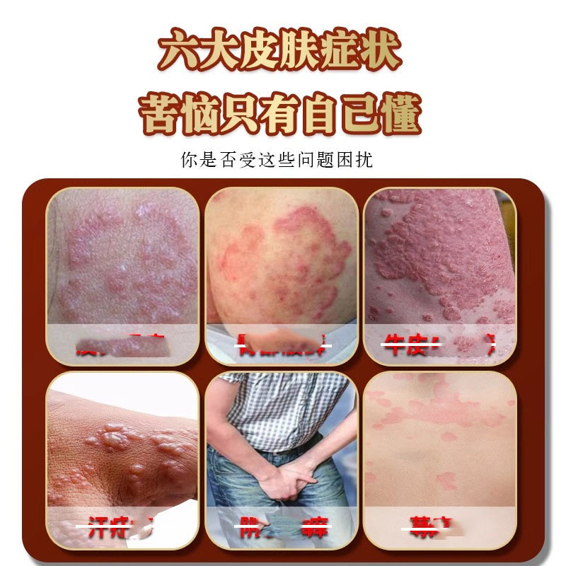 湿診かぶれはかゆみを止めて足の根の皮膚の陰嚢に行ってかゆい牛革の株の頑固な水虫の固皮炎の汗の水疱瘡の薬の膏を取り除きます。|undefined