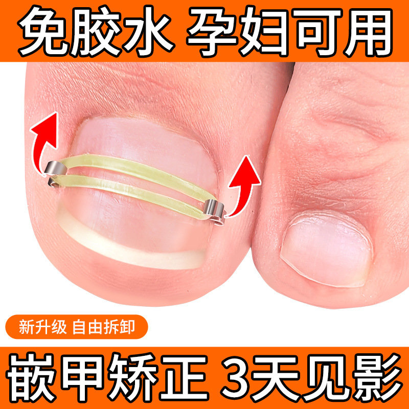 nail buckle nail inlay nail stick nail hook nail groove straightener toe nail long flesh nail curl suit artifact inflammation