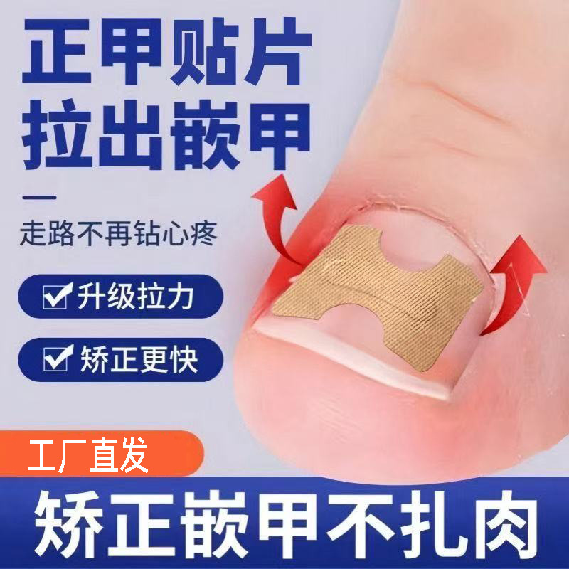 Nail Patch for Ingrown Toenails, Glue-Free Nail Correction Patch for Ingrown Nail Groove, Long Toe Foot Patch, Orthopedic Soft Nail Patch
