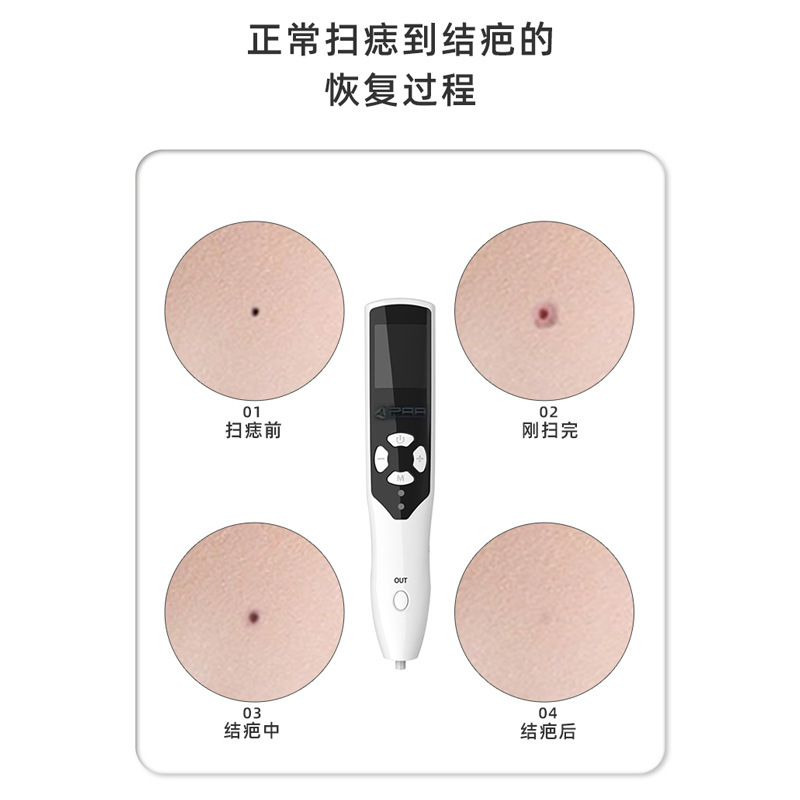 顔のケアのシミ取りのペンの消耗品の家庭の顔のあざを掃く美容器のプラズマのオゾンのペンの消耗品|undefined