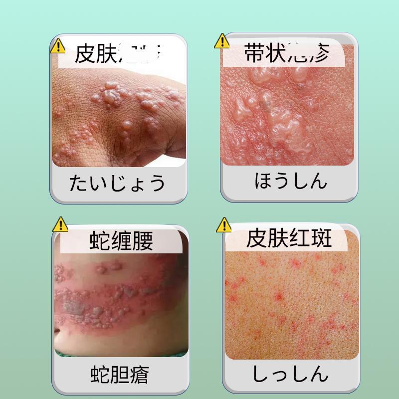 ヘビパンカン軟膏 30g は、腰の皮膚の泡立ち、かゆみや不快感を和らげます。外用絆創膏です。|undefined