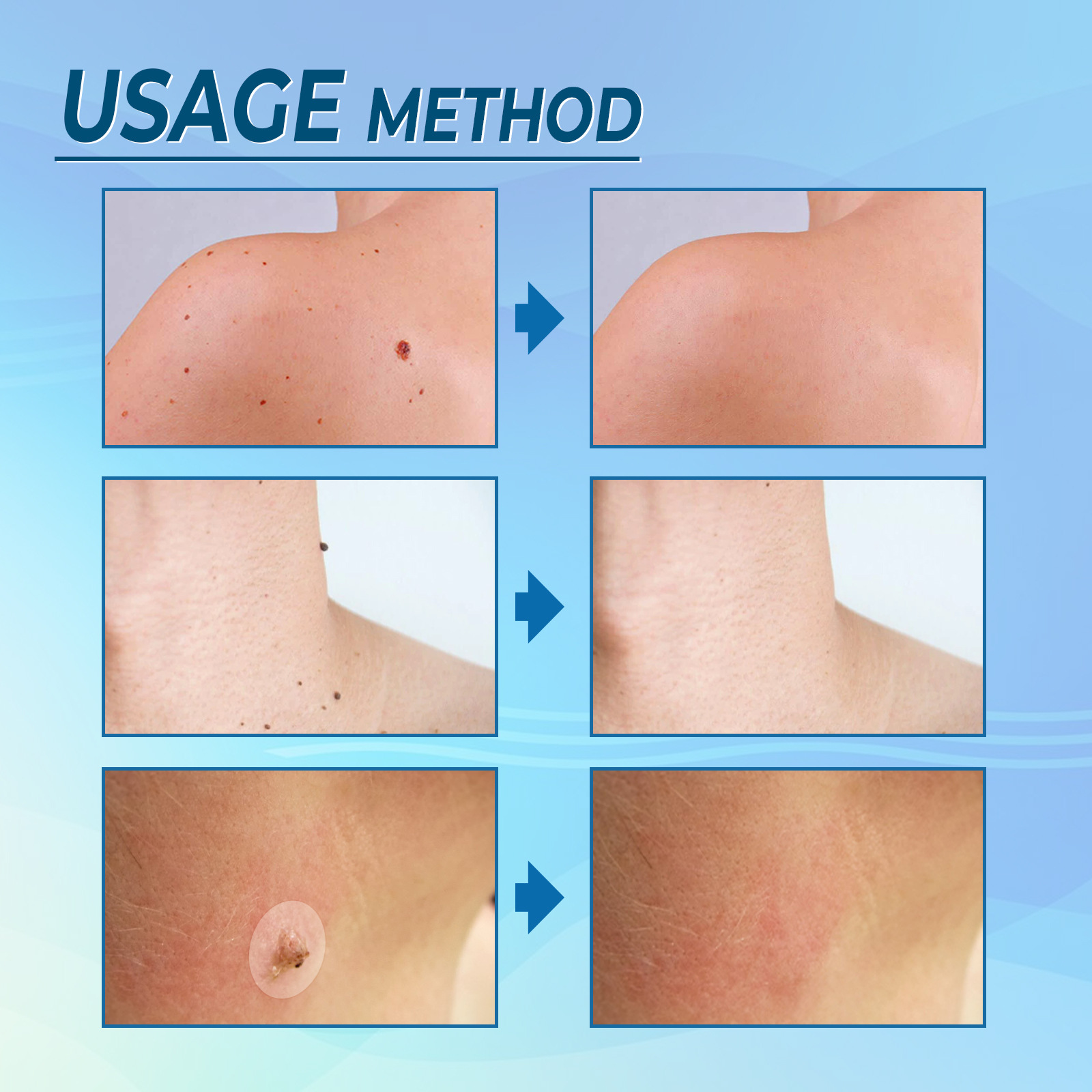 EELHOE Elimineringsplåster för hud Black Memory Curt, Chicken Eyes, Scorpions, Scarless Nevus Cocoon Cleaning and Repair_voghion.com