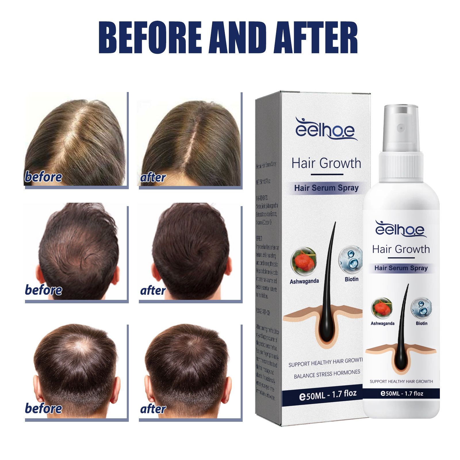 EELHOE essentiële olie voor kruidenverzorging voor verzorging, sterk, stevig haar, preventie van verlies, herstel van dicht haar en_voghion.com