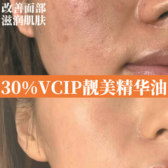 スキンケア 30%vcip 高濃度エッセンスオイル複合植物エッセンスオイルフェイシャル強力な美白若返り 10%vcip