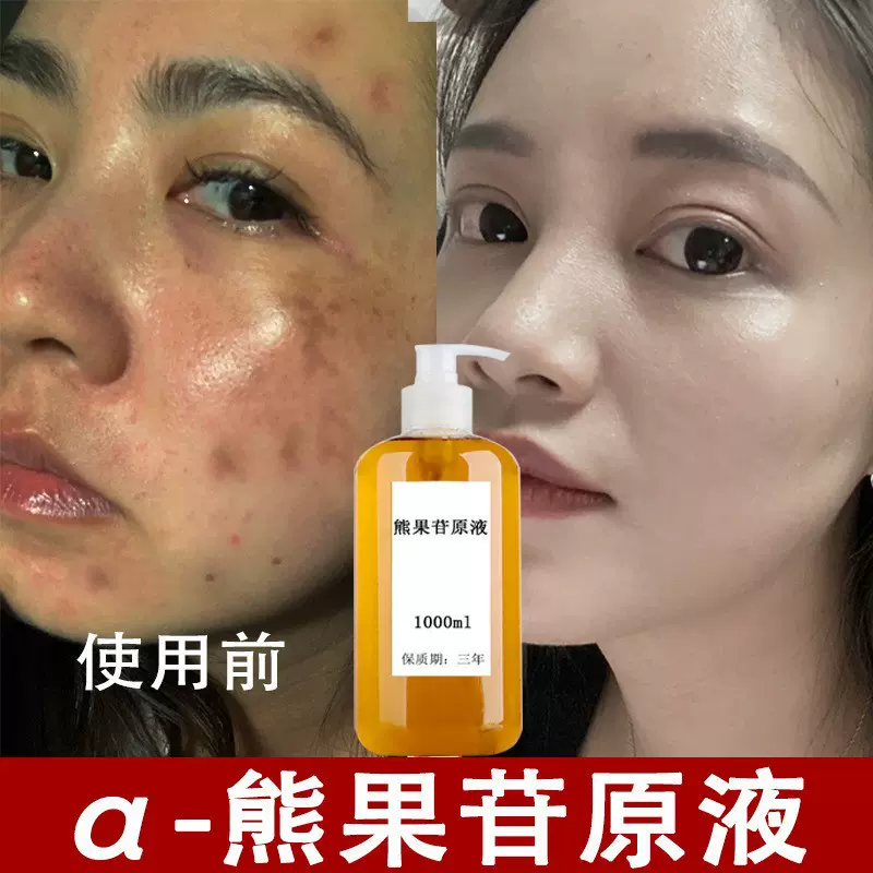 熊果苷原液祛斑液分解色素去黄提亮肤色去老年斑妊娠斑美白去斑液
