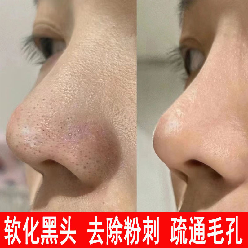 黒頭導出液は黒頭院に小さな気泡にきびを入れて毛包を軟化した角質収縮毛穴エッセンスを浄化する|undefined