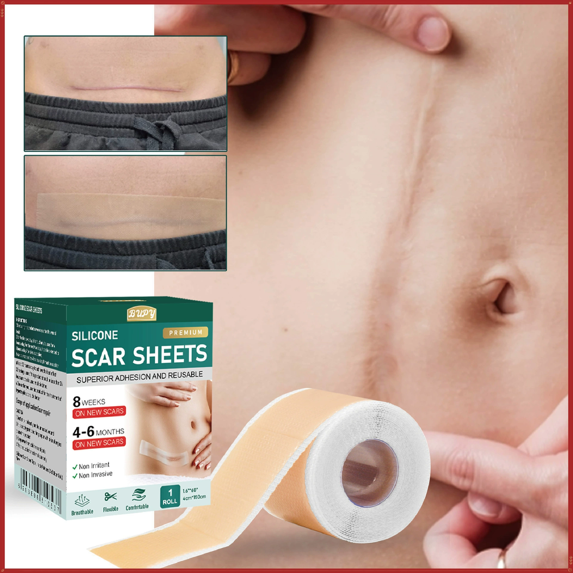 Трансграничный BUPY самоклеящийся шрам стеллаж 1.5m кожа опреснительный рубец уход за раной послеоперационный ремонт силиконовый шрамы