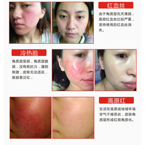 Hormone face repair cream improves sensitive skin repair, reduces redness, removes redness, acne scars, beauty salon live cell repair cream