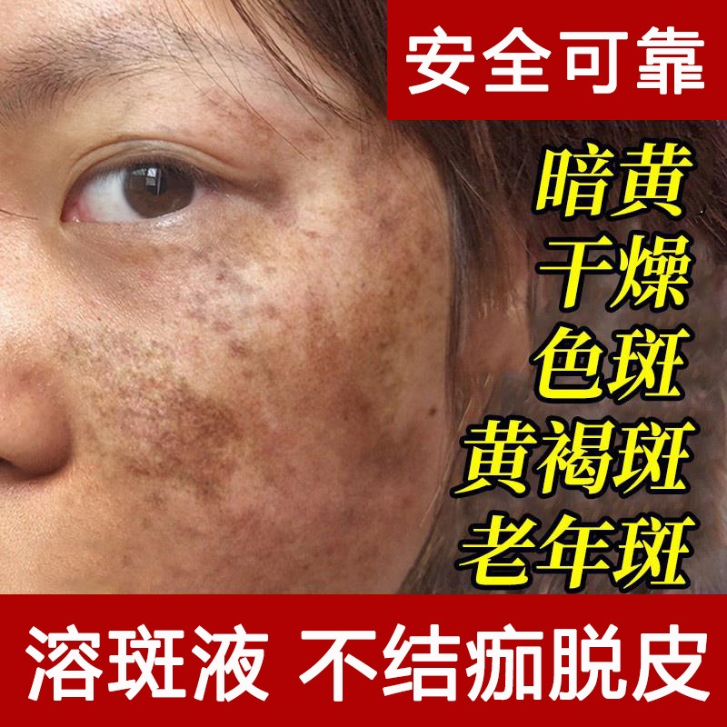 无创溶斑液不脱皮淡斑精华液美容院去雀斑晒斑黄褐斑真皮斑祛斑液