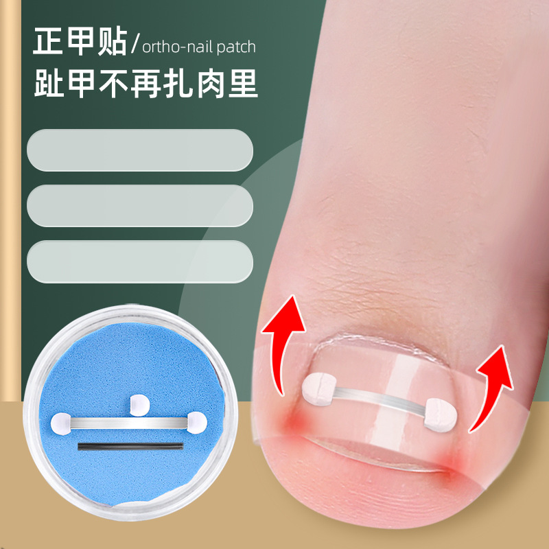 Nail silk nail groove roll nail Lala nail patch toe nail long meat embedded nail traction nail buckle orthosis Nail silk nail groove roll nail Lala nail patch toe nail long meat embedded nail traction nail buckle orthosis