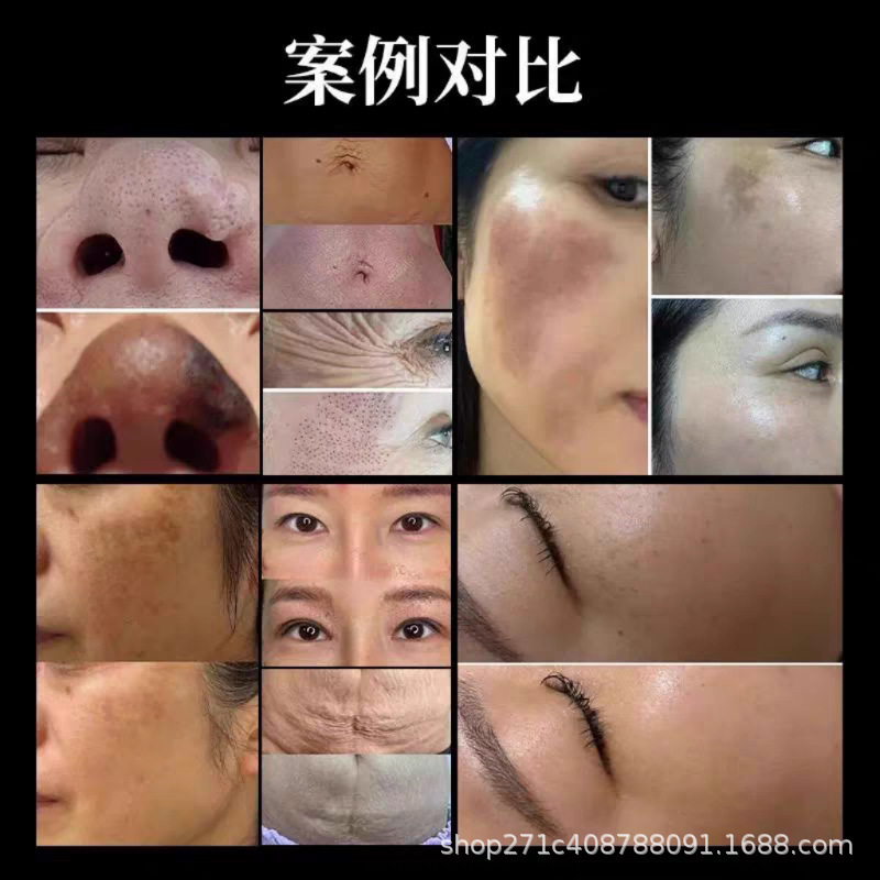 コールドプラズマ美容器、傷跡回復ポイント、ほくろスキャン、ニキビ跡除去、ニキビ穴、顔面導入器、クロスボーダー専用|undefined