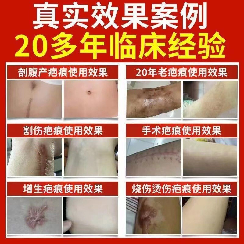 傷跡クリーム、肥厚性、熱傷、古い傷跡の除去と薄め、引き締め、美白クリーム、女性の妊娠修復と鎮静クリーム|undefined