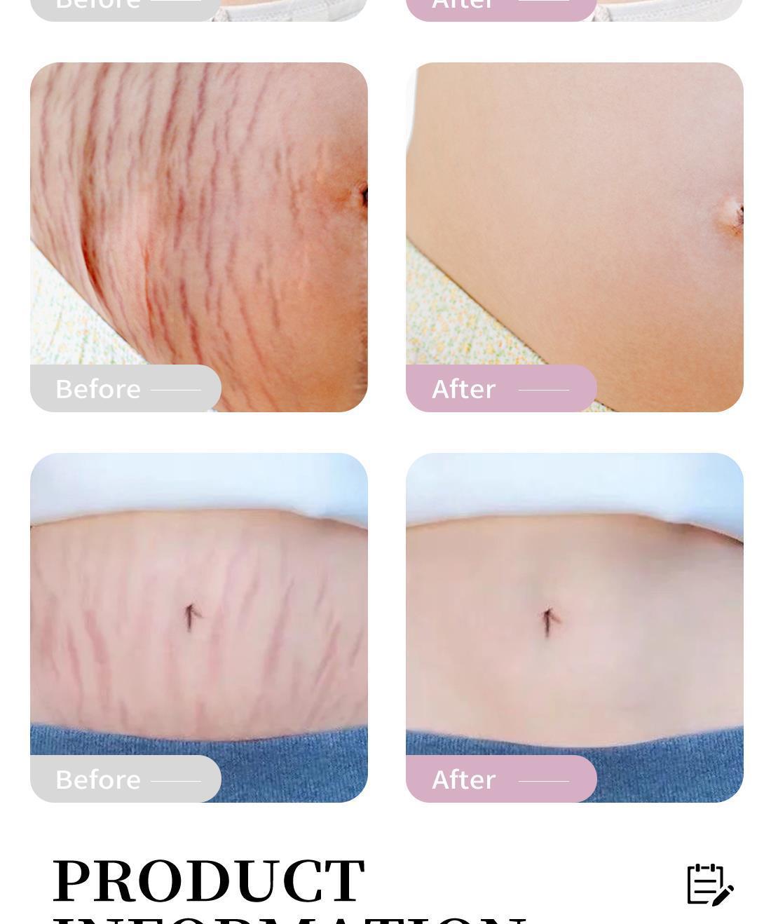 Crema reparadora de estrías para cuello COBEN_voghion.com