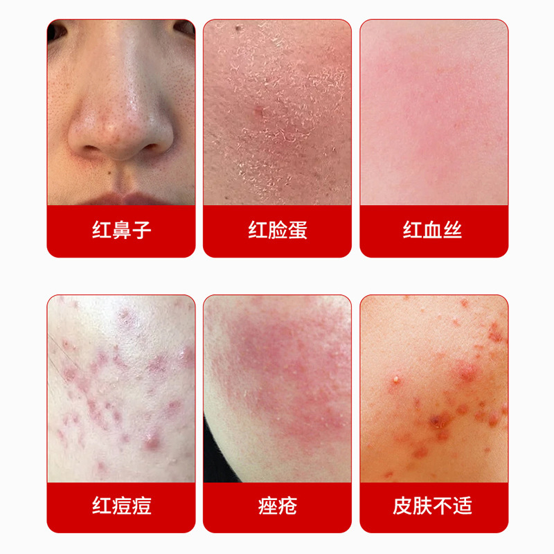 ニキビケア軟膏、湿毒清軟膏、皮膚炎湿疹かゆみ止め外用クリーム、皮膚軟膏（承認済み）|undefined