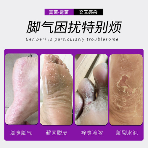 Xinhu Pharmaceutical Co., Ltd. Wolfs poison anti-athlete spray, peeling and anti-itching blister to remove foot odor, itchy feet, athlete's foot medicine manufacturer