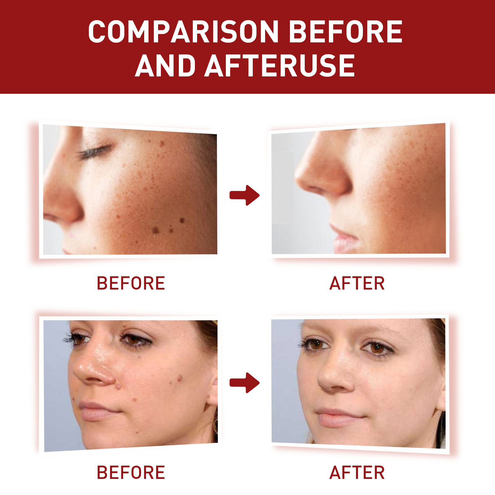 „South Mole“ apgamų šalinimo skystis, gilus odos valymas, karpų mažinimas, juodųjų apgamų atstatymas, odos lyginimo skystis_voghion.com