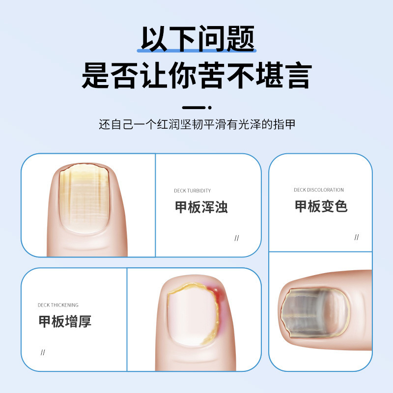 白雲山爪真菌症爪除去クリーム爪真菌症抗菌液特殊薬爪真菌症爪除去液抗菌液|undefined