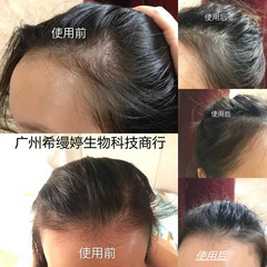 外分泌体角質蛋白増発養髪冷凍乾燥粉髪線ヘアケアセットは毛包暗号化を強化して太くした