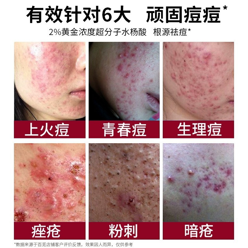 草本のニキビ取りクリームはニキビ印を薄めて保湿してニキビクリームを取り除きます。|undefined