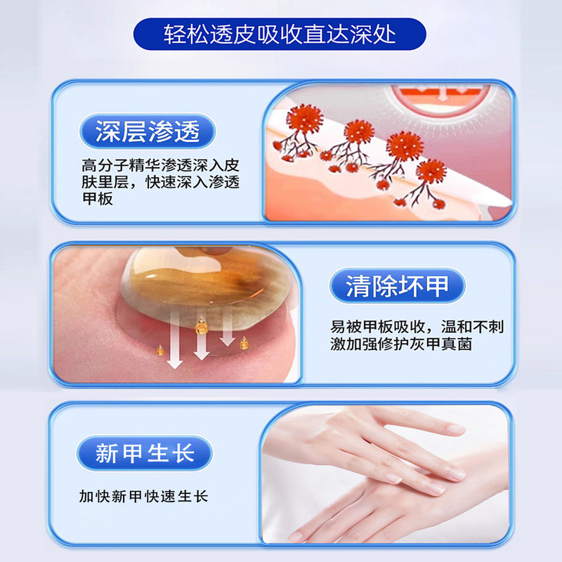 香港大药房凤仙花外用保健液呵护灰指甲坏甲增厚裂甲足部护理液|undefined