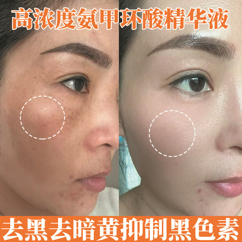 Tranexamic acid essence high concentration nicotinamide stock solution hydrating moisturizing beauty whitening essence tranexamic acid stock solution
