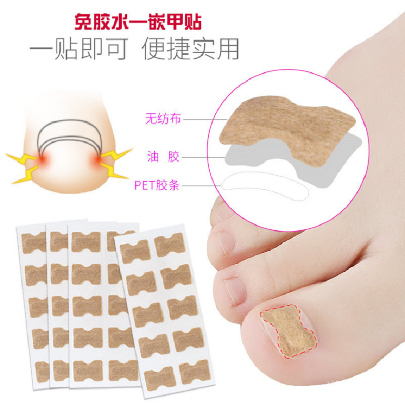 接着剤不使用の爪矯正パッチ、爪溝矯正装置、足の爪パッチ、マニキュア、工場供給|undefined