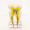Dental teaching model doctor-patient communication model comprehensive case model removable dental model implant restoration model