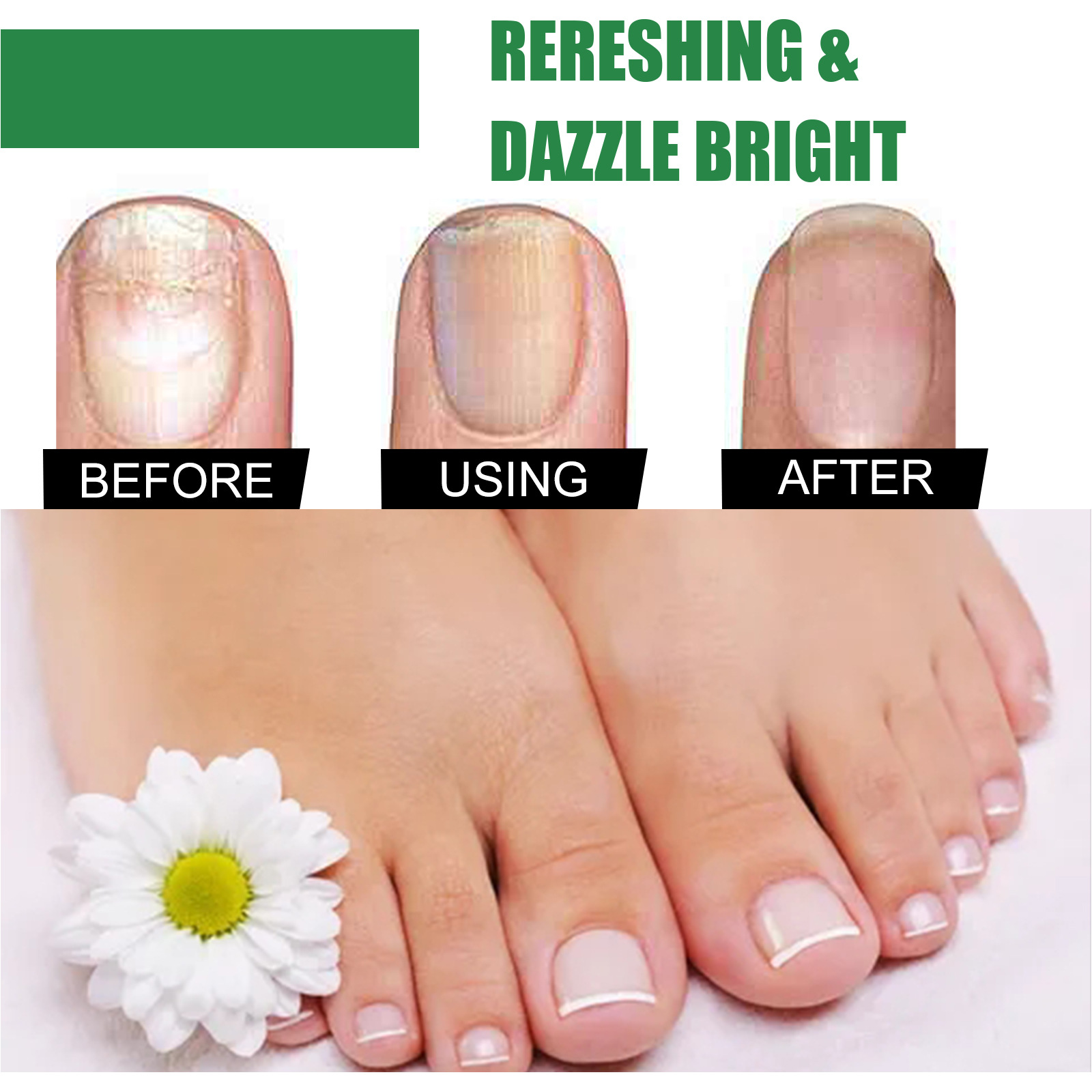 EELHOE Nail Repair Solution, Foot Nail Tea Tree Oil Thick Soft Nail Nourishing Hand and Foot Nail Care Liquid