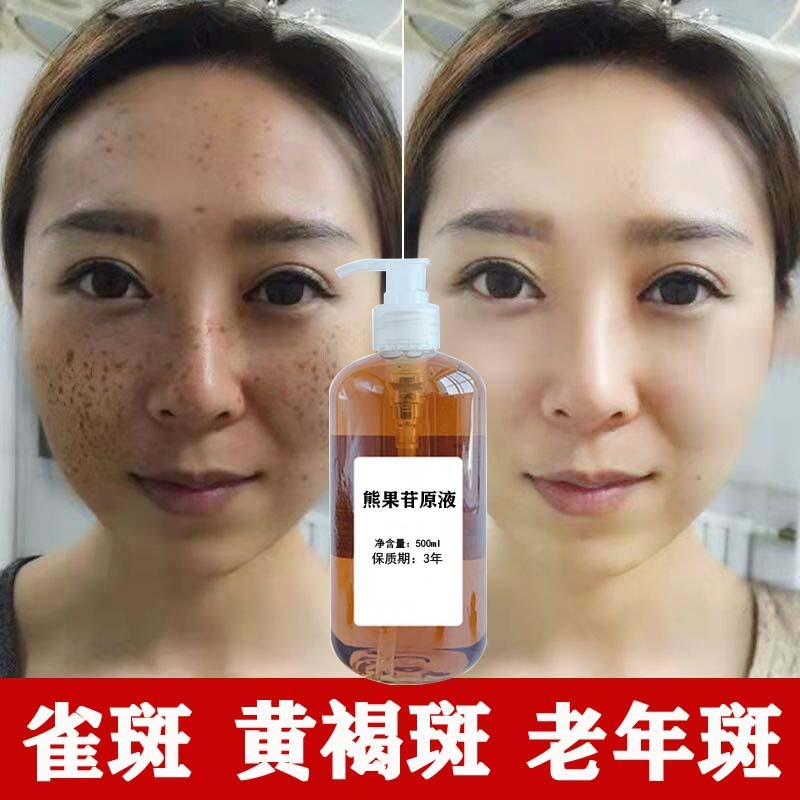 熊果配糖体はぶちを取り除きます。美容院の美白は薄いぶちを取り除きます。|undefined