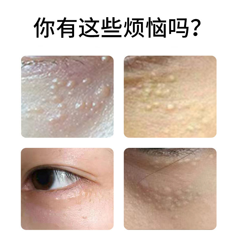 批发日本正品脂肪粒液去汗管粒油脂粒眼周颗粒脸颈部专用一件起批|undefined