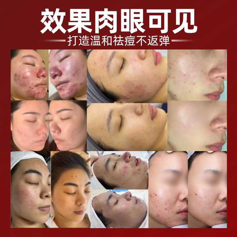 美容院のニキビケアクリームエッセンス、ニキビ跡を薄くし、油分をコントロール、ニキビ除去、閉じたニキビの治療、病院ラインセット、ニキビケアスキンケア|undefined